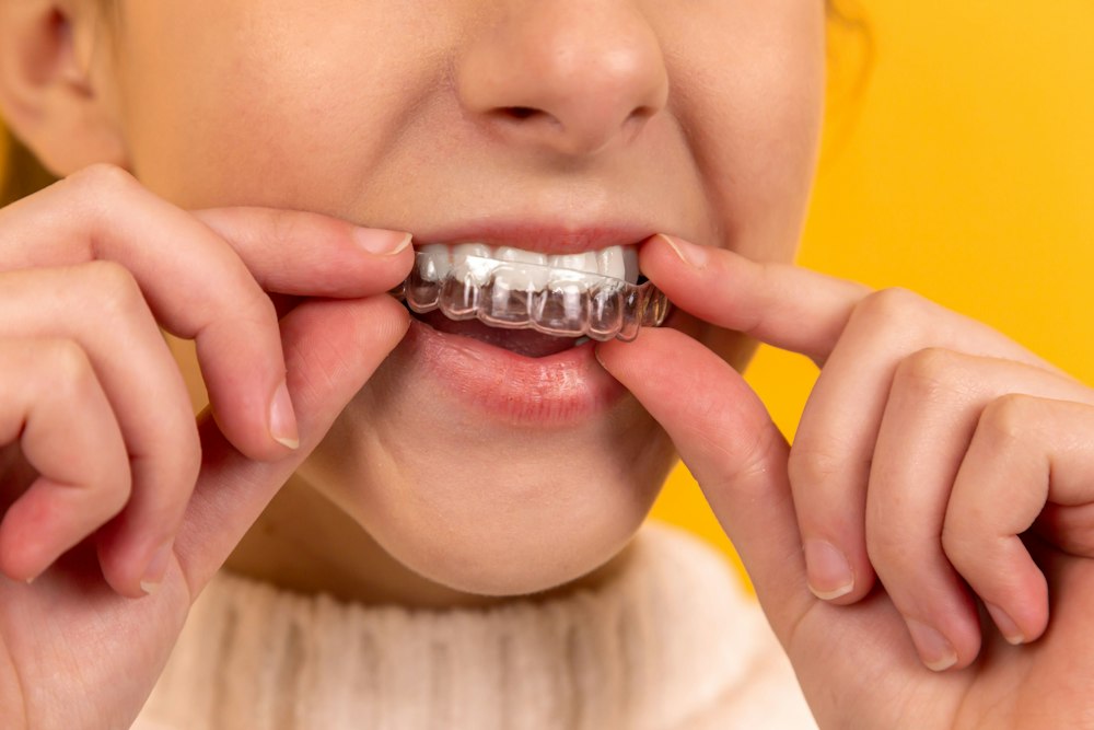 Person placing a transparent dental aligner over their teeth